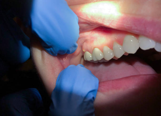 Best Emergency Tooth Extraction in Center, TX